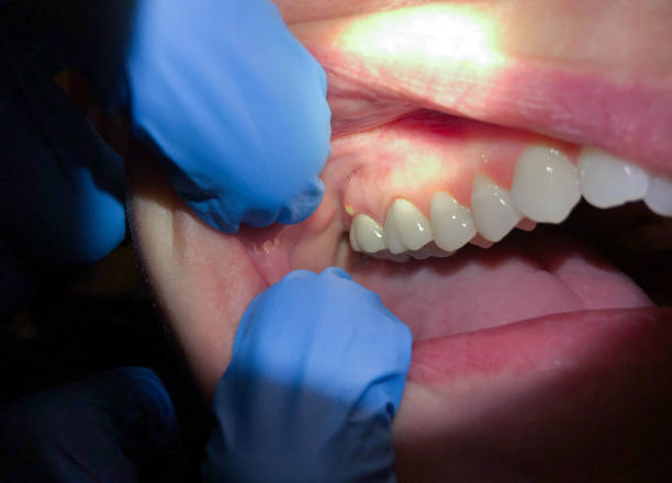 Best Urgent Tooth Repair  in Machias, WA